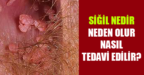 human papilloma virus nas l tedavi edilir