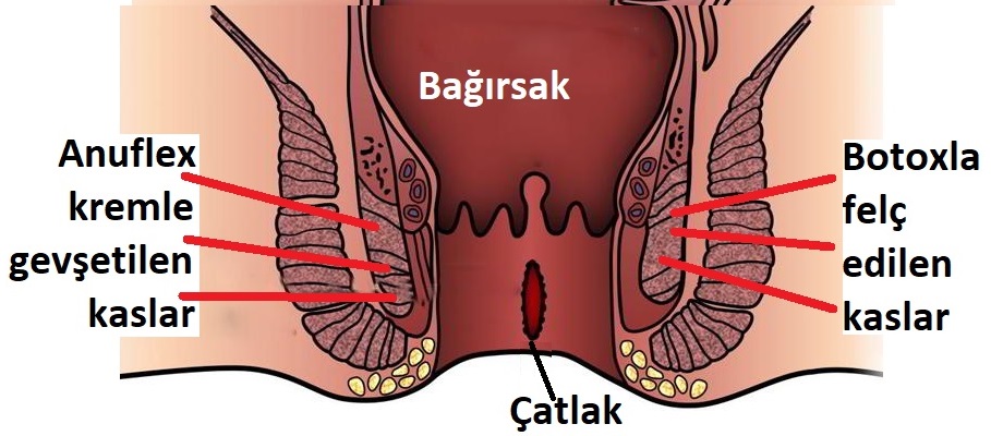 anal fissur hastaliginin bitkisel kremle tedavisi