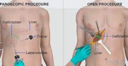 Kapalı ve açık safra kesesi ameliyatı