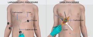 Kapalı ve açık safra kesesi ameliyatı